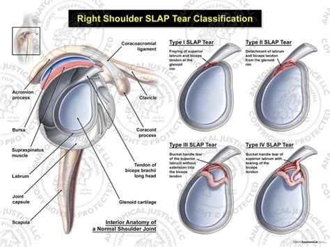 slap type labral tear